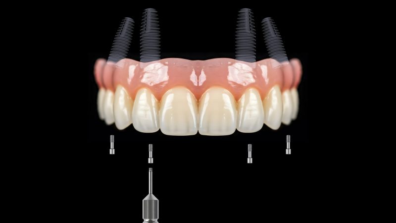 Dental,Implant,Treatment,Applied,To,Edentulous,Jaws,In,Dental,Dentistry.