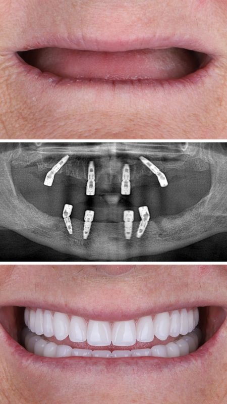 Implant surgery treatment applied in edentulous jaws in dental dentistry. Jawbone implant treatment called All on Four and All on X dental before and after and Xray images. smile makeover dent